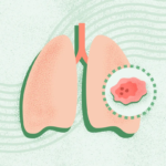 What Is Lung Cancer?