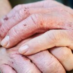 What Is Dyshidrotic Eczema?