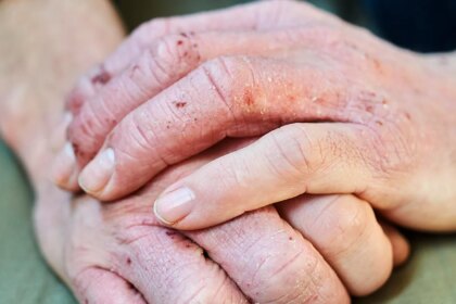 What Is Dyshidrotic Eczema?