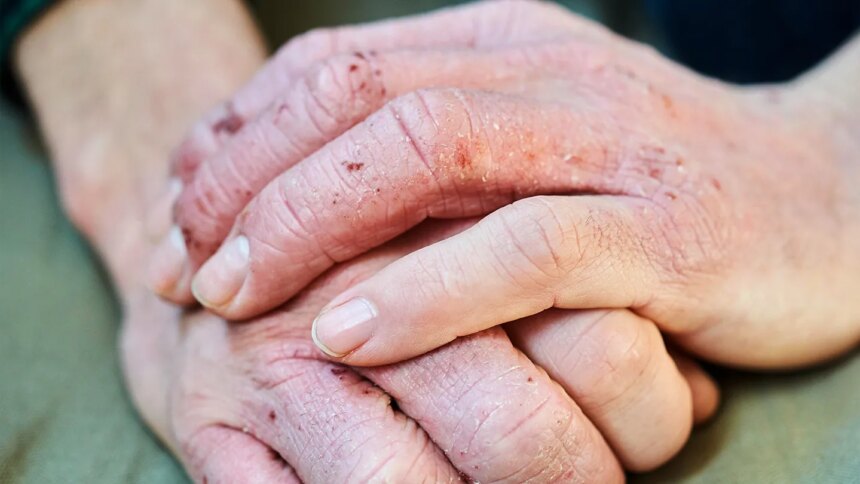 What Is Dyshidrotic Eczema?
