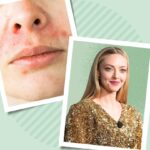 What Is Perioral Dermatitis?