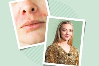 What Is Perioral Dermatitis?