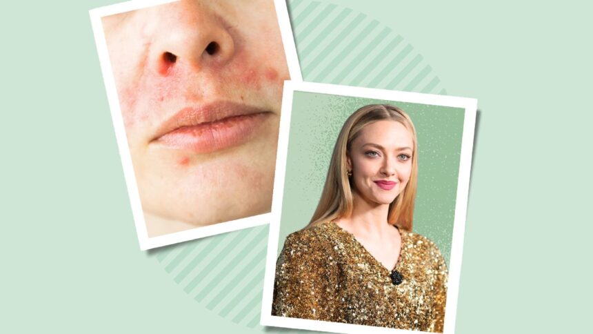 What Is Perioral Dermatitis?