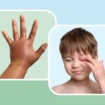 How to Recognize a Hereditary Angioedema Episode on 7 Body Parts
