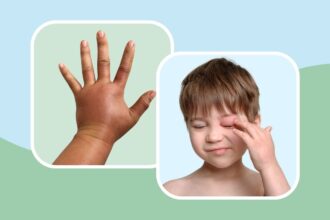 How to Recognize a Hereditary Angioedema Episode on 7 Body Parts