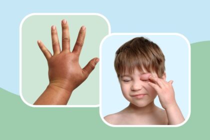 How to Recognize a Hereditary Angioedema Episode on 7 Body Parts