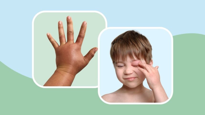 How to Recognize a Hereditary Angioedema Episode on 7 Body Parts