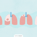 What Is Lung Cancer Surgery?