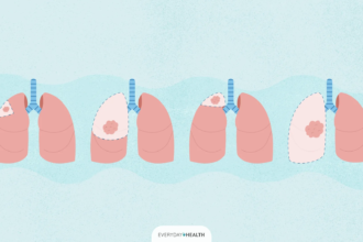 What Is Lung Cancer Surgery?