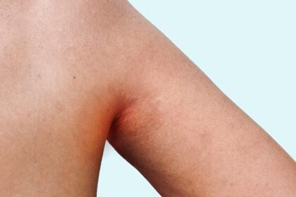 How to Spot and Treat Inverse Psoriasis