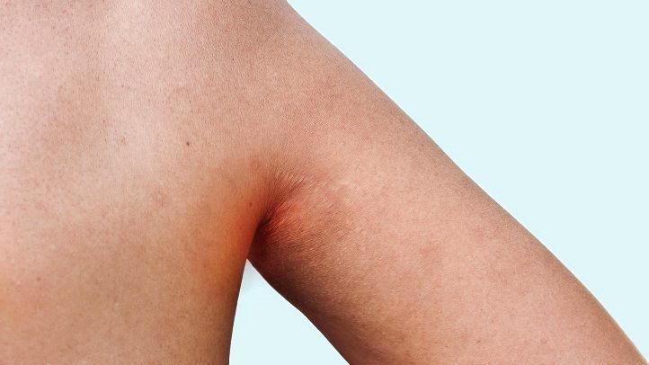 How to Spot and Treat Inverse Psoriasis