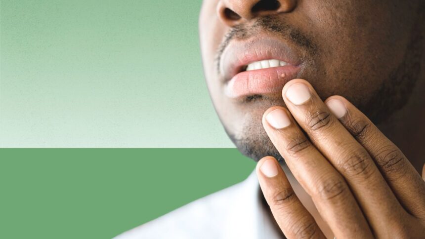 Black man concerned about a blister on his lip
