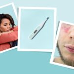 Lupus Symptoms