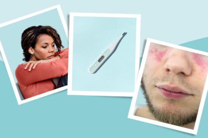 Lupus Symptoms