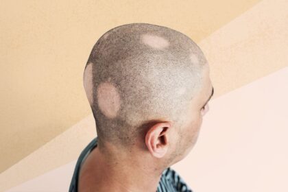 What Are the Different Types of Alopecia Areata?