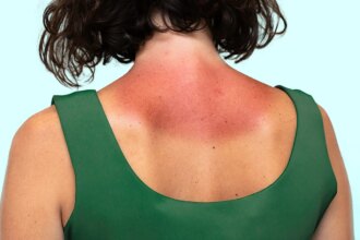 What Is Sun Poisoning? Plus, How to Treat and Prevent It