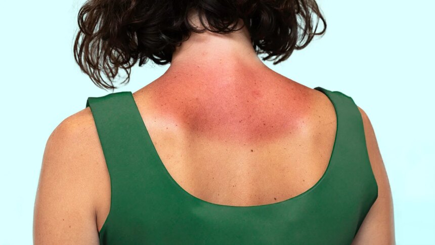 What Is Sun Poisoning? Plus, How to Treat and Prevent It
