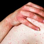 Anaphylaxis Symptoms and Diagnosis