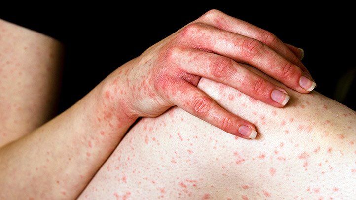 Anaphylaxis Symptoms and Diagnosis