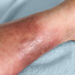 Cellulitis Symptoms
