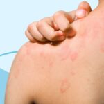 Does Chronic Spontaneous Urticaria Ever Go Away?