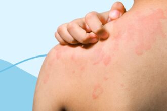 Does Chronic Spontaneous Urticaria Ever Go Away?