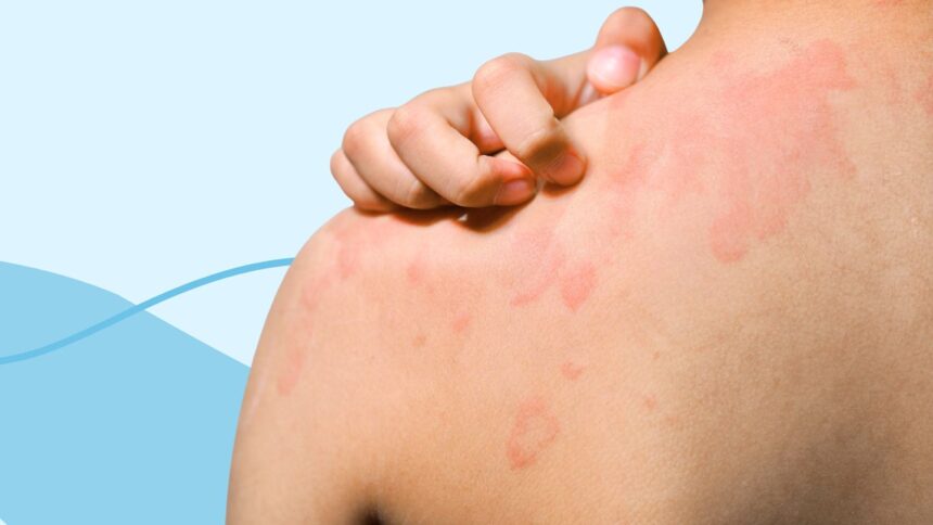 Does Chronic Spontaneous Urticaria Ever Go Away?