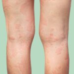 6 Ways to Ease the Itch From Chronic Spontaneous Urticaria