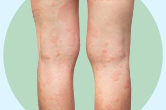 6 Ways to Ease the Itch From Chronic Spontaneous Urticaria