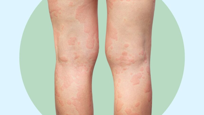 6 Ways to Ease the Itch From Chronic Spontaneous Urticaria