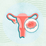What Is Uterine (or Endometrial) Cancer?