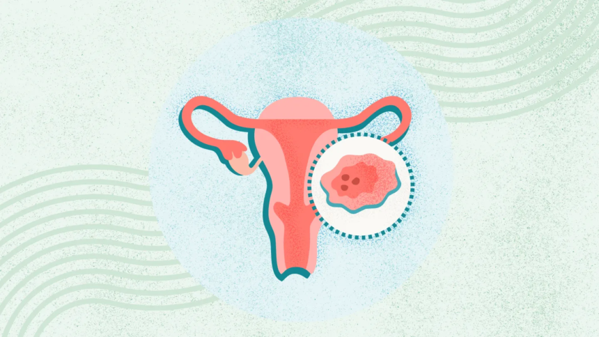 What Is Uterine (or Endometrial) Cancer?