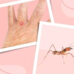 Everything You Need to Know About Ant Bites