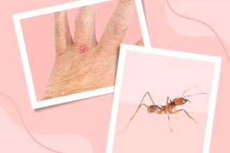 Everything You Need to Know About Ant Bites