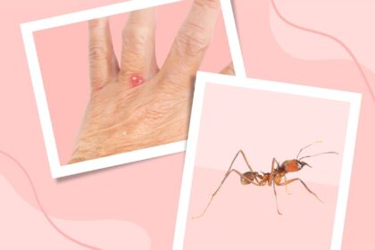Everything You Need to Know About Ant Bites