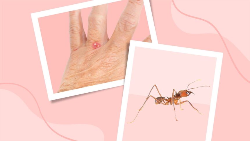 Everything You Need to Know About Ant Bites