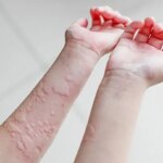 Causes of Hives