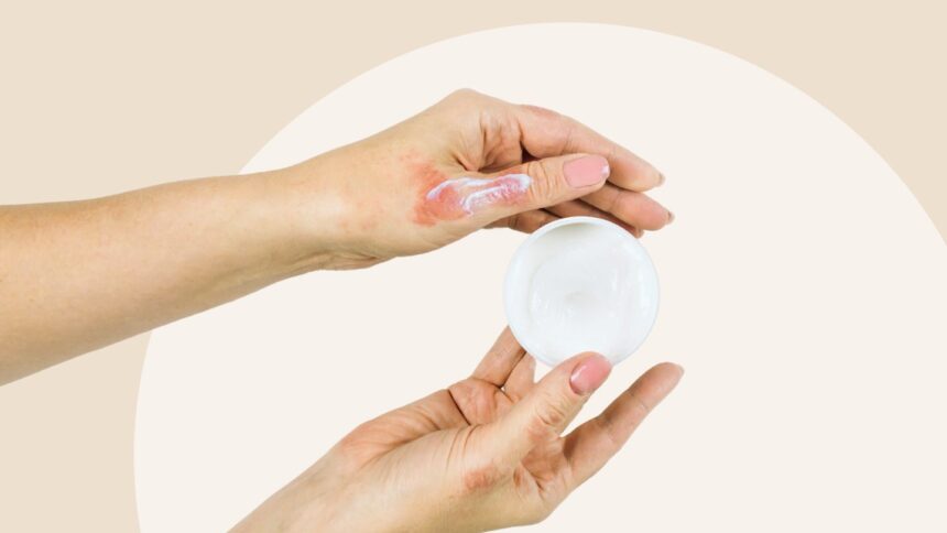 How to Manage Atopic Dermatitis Pain