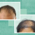 Male vs. Female Pattern Baldness (Androgenetic Alopecia): What’s the Difference?