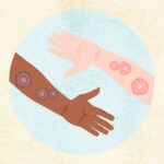 What Is Ringworm? Symptoms, Causes, Diagnosis, Treatment, and Prevention