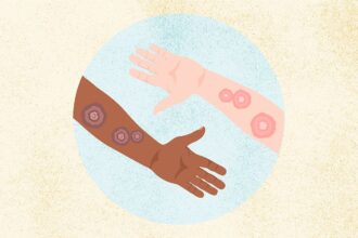 What Is Ringworm? Symptoms, Causes, Diagnosis, Treatment, and Prevention