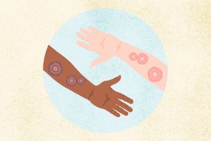 What Is Ringworm? Symptoms, Causes, Diagnosis, Treatment, and Prevention
