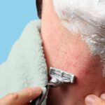 What Is Razor Burn? Symptoms, Causes, Diagnosis, Treatment, and Prevention